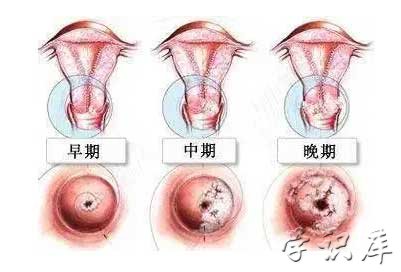 宫颈癌早期症状